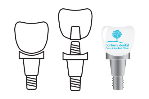 What is a dental implant?