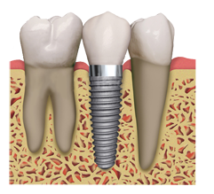 Horbury Dental Implants
