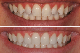 Before & After Teeth Whitening