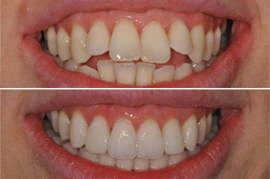 Before & After Teeth Whitening