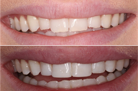 Before & After Teeth Whitening