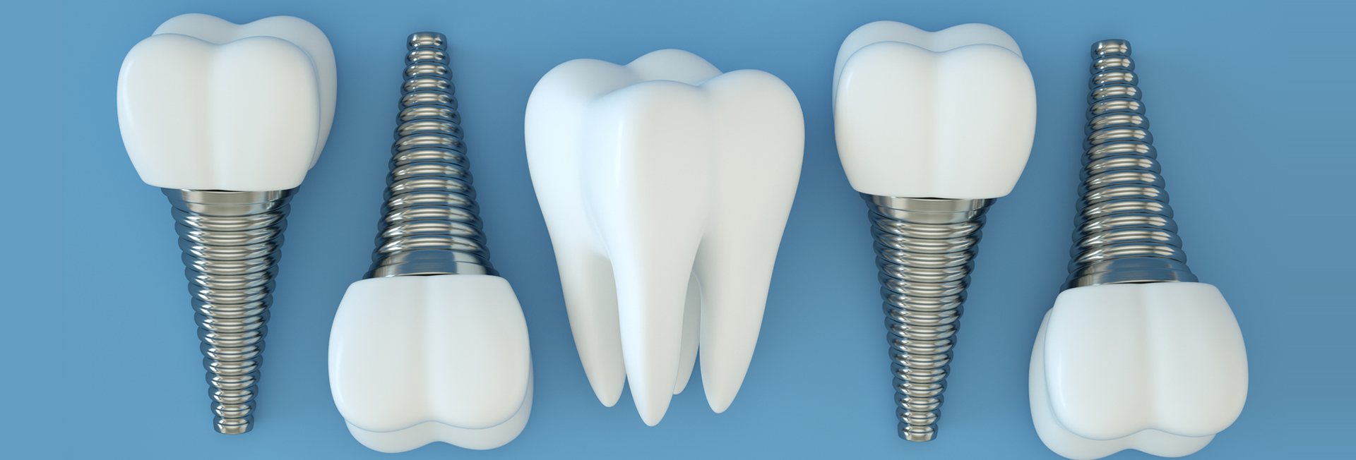 Dental Implants