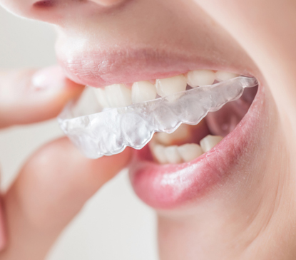 What are the benefits of Invisalign?