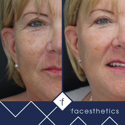 skinpen microneedling before and after
