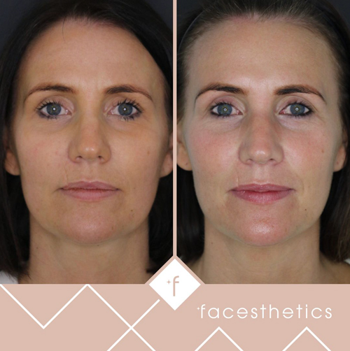 zo skin health products before and after