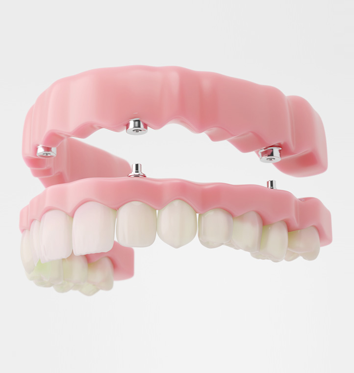 Dentist fitting secure dental implants for dentures in Wakefield