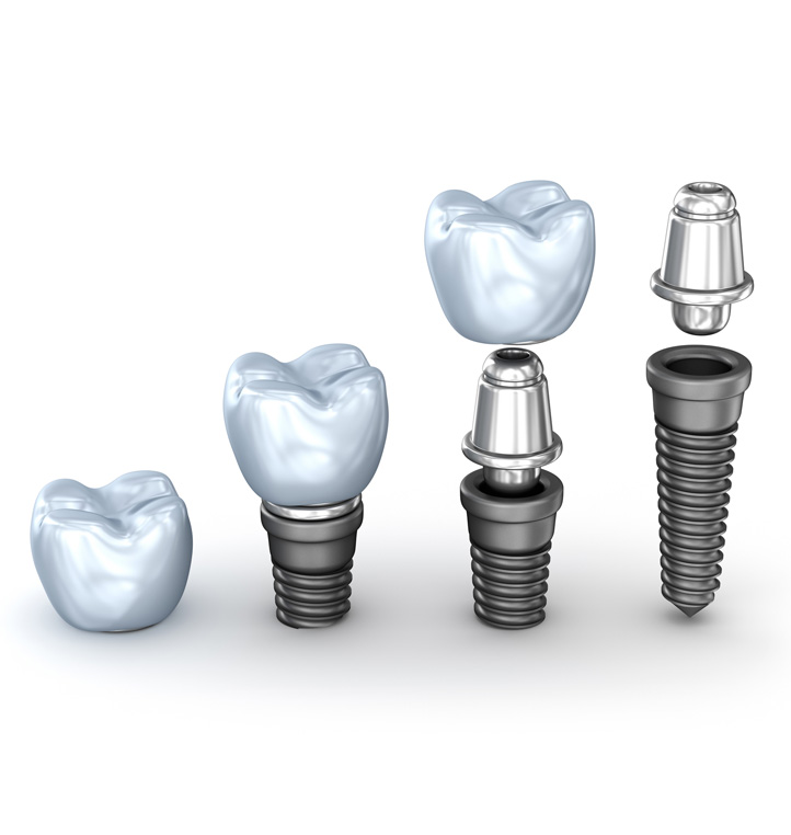 Patient smiling after Same Day Dental Implants at Horbury Dental & Implant Clinic