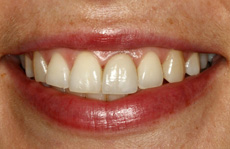 After Treatment