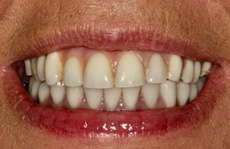 After Treatment
