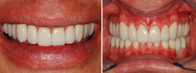 After Treatment