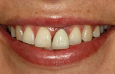 Before Treatment