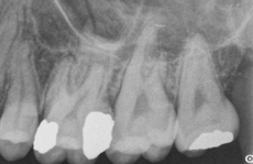 Before Treatment