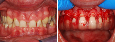 Before Treatment